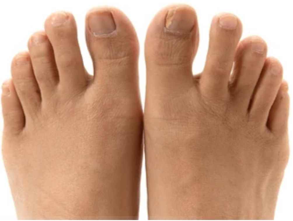 Toenail fungus of both feet
